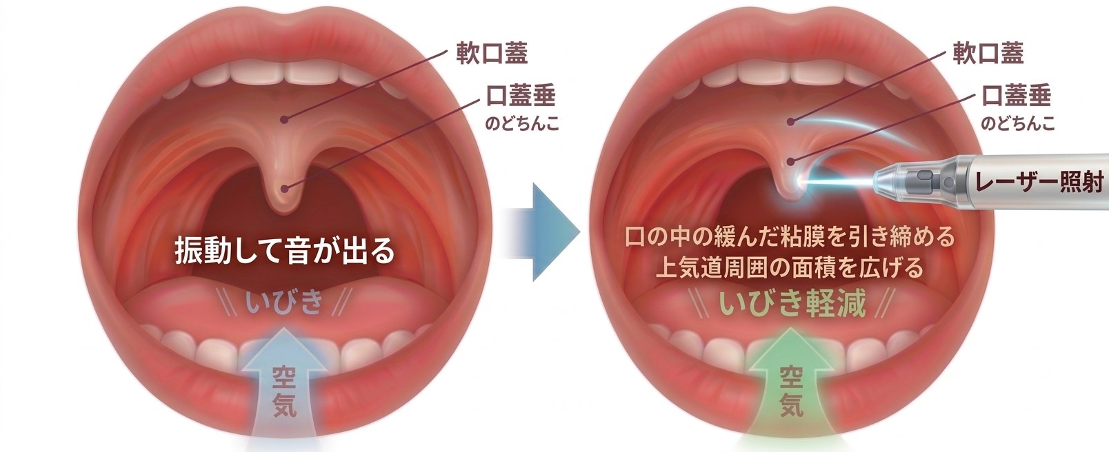 左：ゆるんだ軟口蓋と口蓋垂が振動していびきの音が出る状態。右：Er:YAGレーザーを照射して粘膜を引き締め、上気道周囲の面積を広げ、いびきを軽減する仕組み